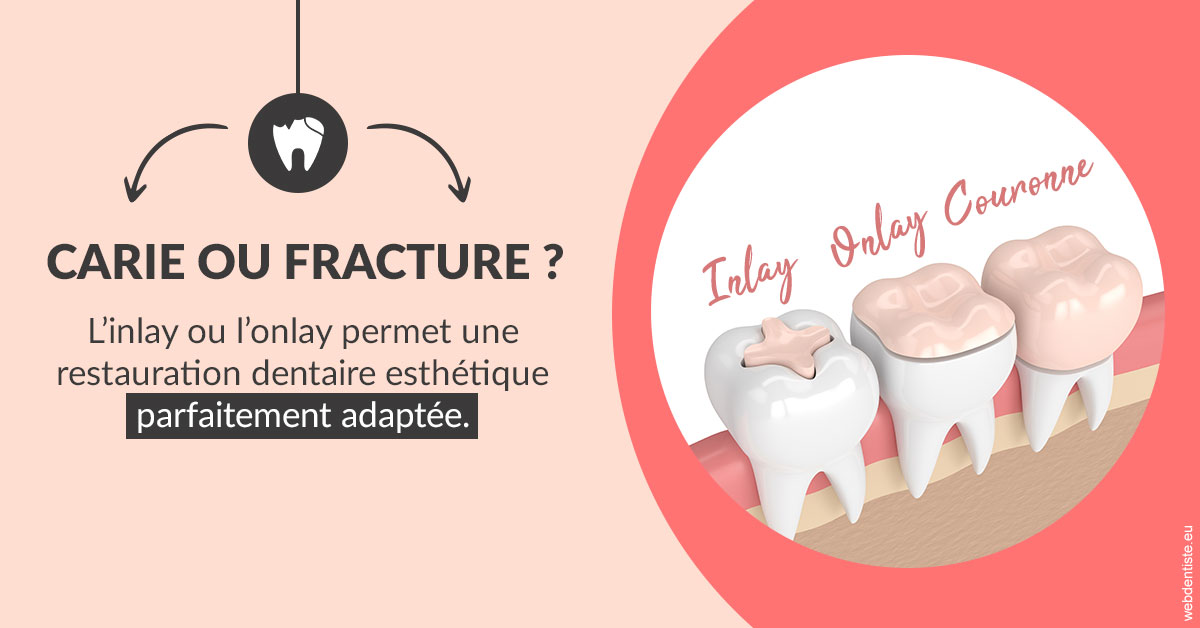 https://dr-geffray-justine.chirurgiens-dentistes.fr/T2 2023 - Carie ou fracture 2