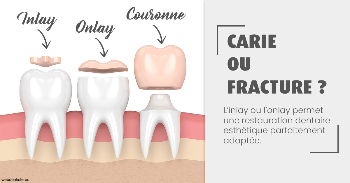 https://dr-geffray-justine.chirurgiens-dentistes.fr/T2 2023 - Carie ou fracture 1