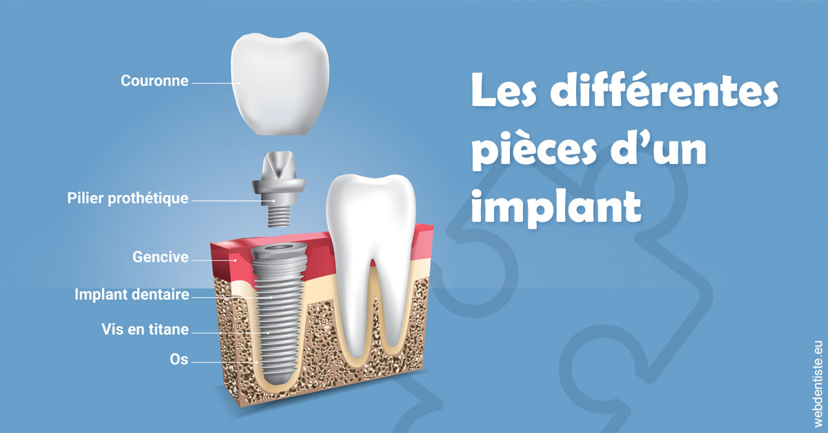 https://dr-geffray-justine.chirurgiens-dentistes.fr/Les différentes pièces d’un implant 1
